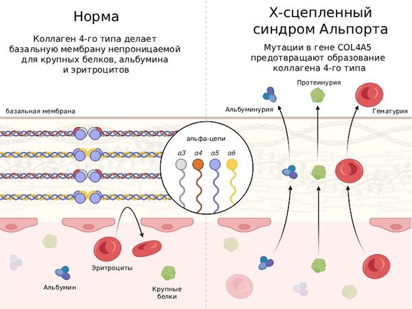 Патогенез синдрома Альпорта