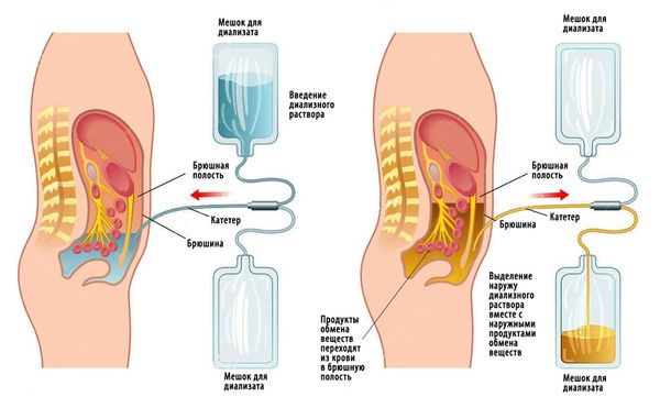 Перитонеальный диализ