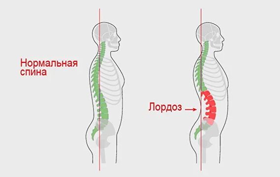 Лордоз