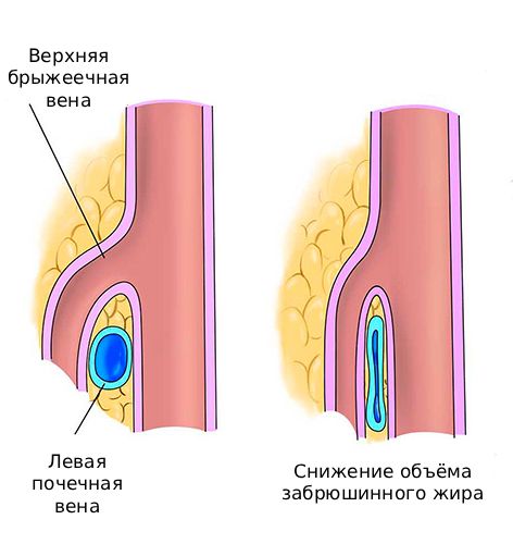 Маленький объём забрюшинного жира