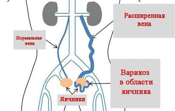 Варикозное расширение вен малого таза у женщины Варикозное расширение вен малого таза у женщины