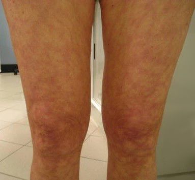 Сосудистый рисунок при синдроме Снеддона [14]