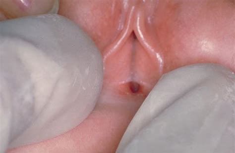Операция по коррекции малых половых губ