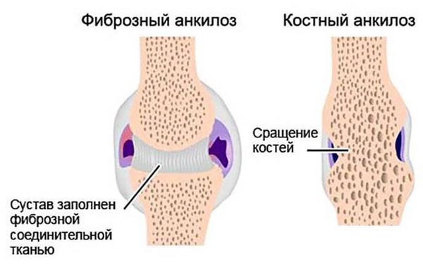 Развитие костного анкилоза