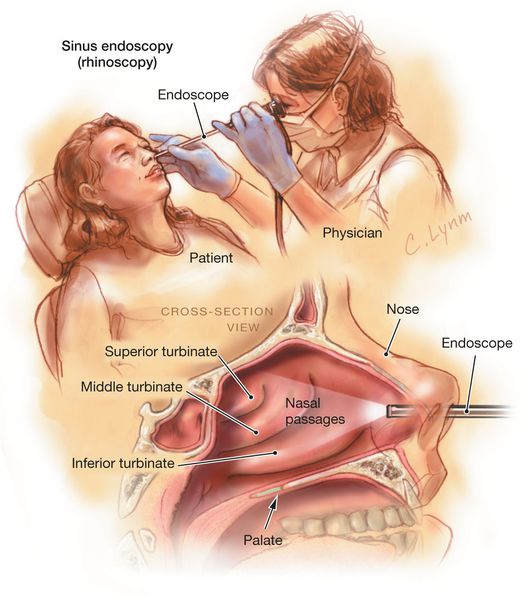Эндоскопия пазух носа