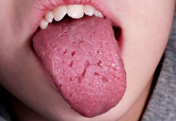 Складчатый язык ребёнка с синдромом Дауна
