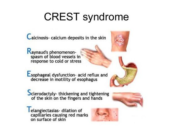 crest sindrom s