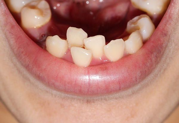 Синдром тесного расположения зубов