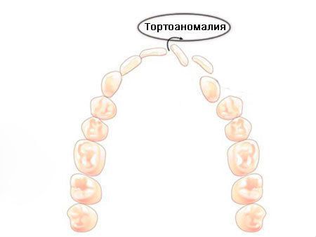 Тортоаномалия – поворот зуба вокруг продольной оси