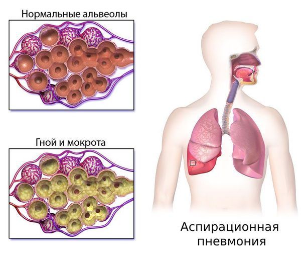 Аспирационная пневмония