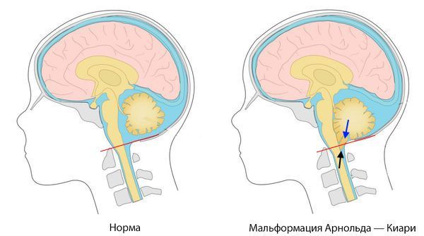 Аномалия Арнольда — Киари