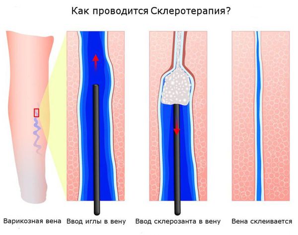 Процесс склеротерапии