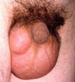 Крупная киста придатка