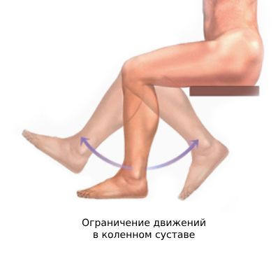 Ограничение движений в коленном суставе Ограничение движений в коленном суставе
