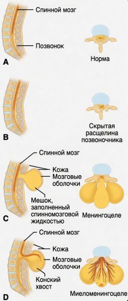 Разновидности спины бифида