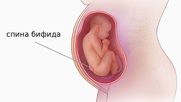 Спина бифида [19]