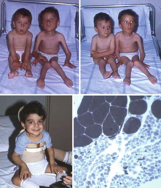 Спинальная амиотрофия Верднига — Гоффмана [19]