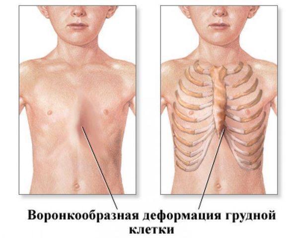 Воронкообразная грудная клетка Воронкообразная грудная клетка