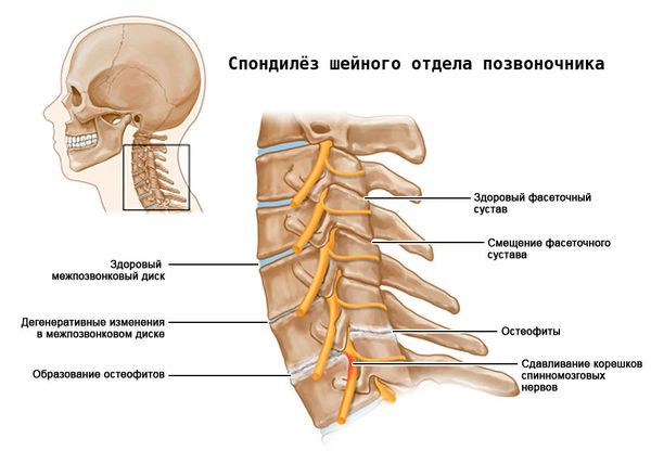 Шейный спондилёз Шейный спондилёз