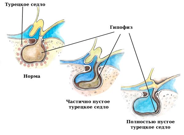 Гипофиз в норме и при СПТС