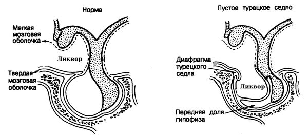 Расположение диафрагмы. Гипофиз в норме и при СПТС [26]