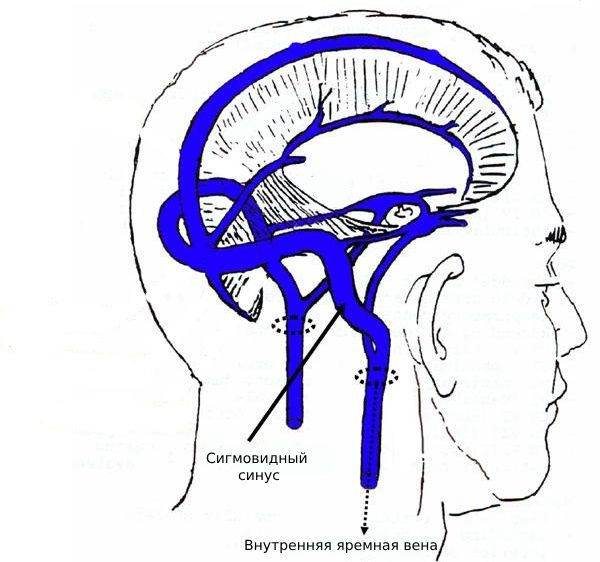 Сигмовидный синус