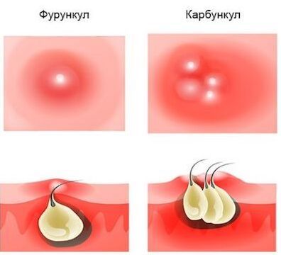 Фурункул и карбункул