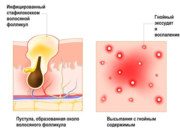 Фурункул: лечение, вскрытие, обработка