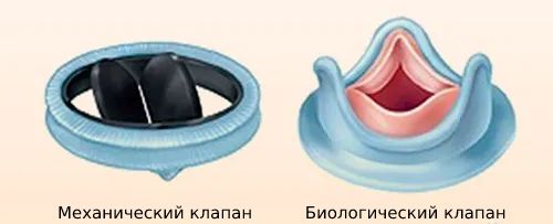 Биологический и механический клапан