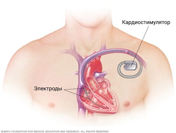 Лечение атеросклероза аорты и болезни периферических артерий в Одессе - Клиника Шевченко
