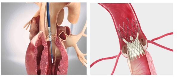 Транскатетерная имплантация аортального клапана (TAVI) 