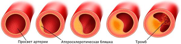 ateroskleroticheskaya blyashka i tromb v prosvete arterii s