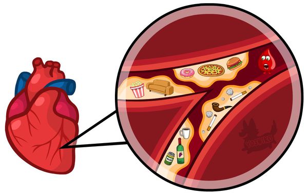Факторы риска развития стеноза коронарных артерий