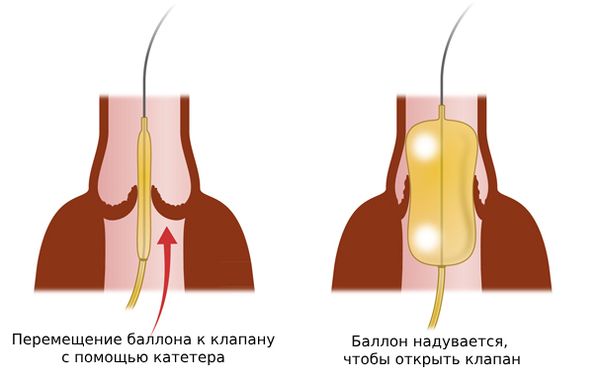 Чрескожная баллонная вальвулотомия