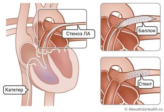 Стентирование