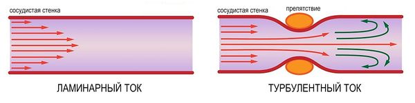 Турбулентный ток крови
