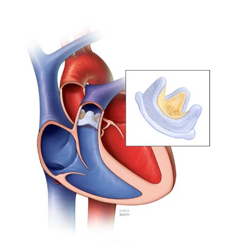 Замена клапана