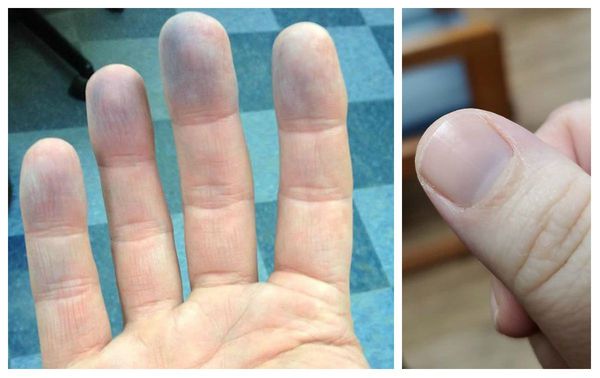 Цианоз пальцев