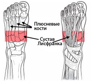 Сустав Лисфранка Сустав Лисфранка