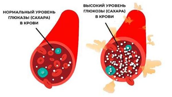 Утренняя гипергликемия: причины