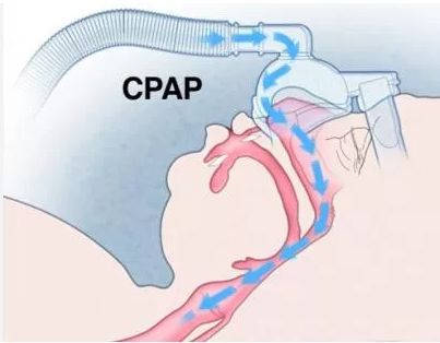 CPAP-терапия