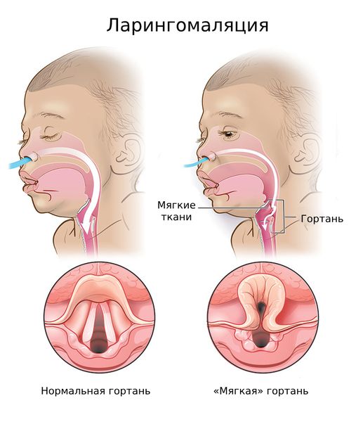Ларингит у детей