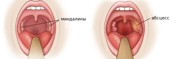 Заглоточный абсцесс
