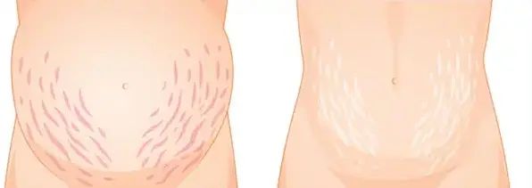 Красные и белые стрии