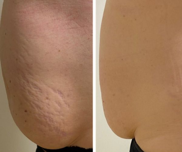 Результат лазерной терапии стрий [17]