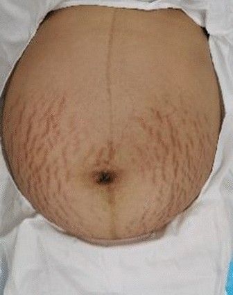 Стрии при беременности [7]