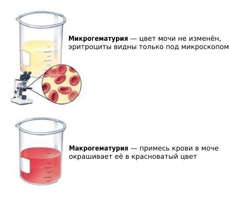 какое сужение мочеточника является наиболее узким