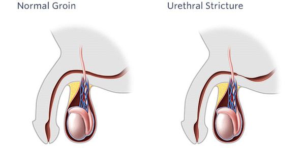Urethritis symptome