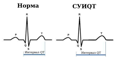 ЭКГ в норме и при СУИQT