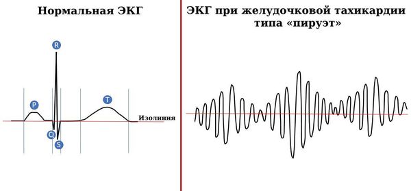 ЭКГ в норме и при желудочковой тахикардии типа «пируэт»